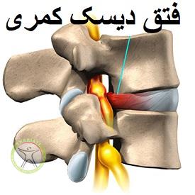 http://scpt.ir/uploads/lumbar-disc-herniation-physiotherapy.jpg