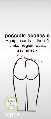 http://scpt.ir/uploads/lumbar-hump-scoliosis-treatment-scoliosis-lumbar.jpg