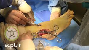 surgery ankle fracture
