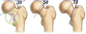 http://scpt.ir/uploads/pauwels-femoral-fracture-classification.jpg