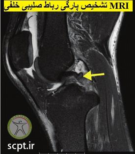 http://scpt.ir/uploads/posterior-cruciate-ligament-tear-MRI-diagnosis.jpg