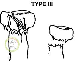 http://scpt.ir/uploads/radial-head-fracture-Mason-classification-type-3.jpg