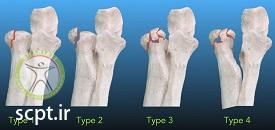 http://scpt.ir/uploads/radial-head-fracture-classification-1.jpg