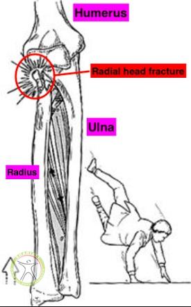 http://scpt.ir/uploads/radial-head-fracture-mechanism-of-injury.jpg