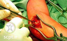 http://scpt.ir/uploads/radial-head-fracture-surgery.jpg