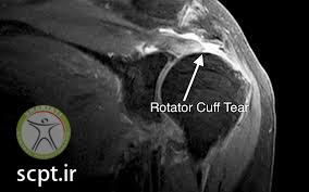 http://scpt.ir/uploads/rotator cuff tear MRI diagnosis.jpg