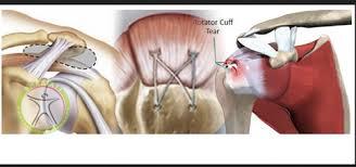 http://scpt.ir/uploads/rotator cuff tear surgery.jpg
