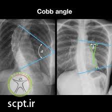 http://scpt.ir/uploads/scoliosis-cobb-angle-2.jpg