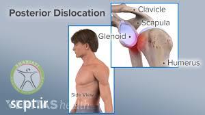 http://scpt.ir/uploads/shoulder dislocation 3.jpg