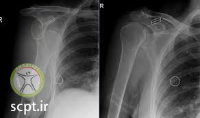 http://scpt.ir/uploads/shoulder islocation x ray.jpg