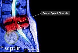 http://scpt.ir/uploads/spinal stenosis MRI.jpg