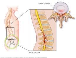 http://scpt.ir/uploads/spinal stenosis.jpg