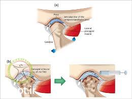 http://scpt.ir/uploads/temporomandibular joint disorder lateral pterygoid.jpg