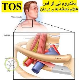 http://scpt.ir/uploads/thoracic-outlet-syndrome.jpg