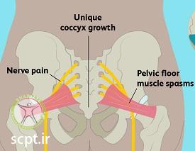 http://scpt.ir/uploads/treatment-of-tailbone-pain-causes-1.jpg