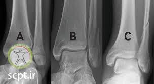 type of fracture ankle 