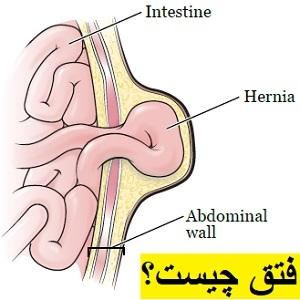 complications-of-hernia