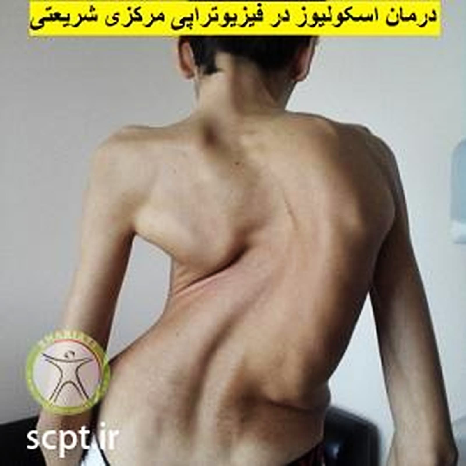اسکولیوز یا انحراف جانبی ستون فقرات-انواع اسکولیوز-تشخیص و درمان-فیزیوتراپی شریعتی