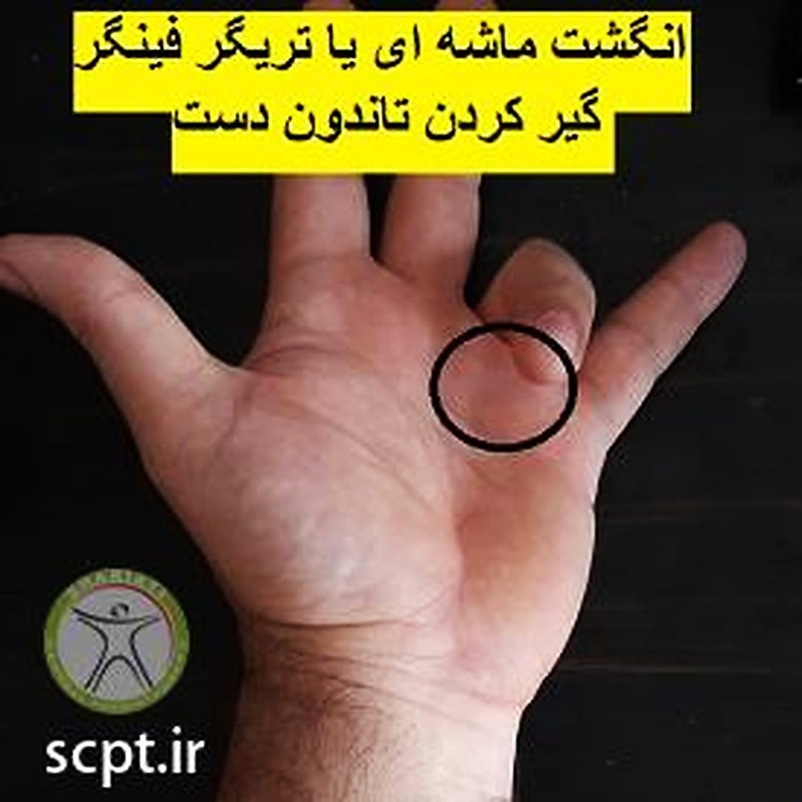 انگشت ماشه ای یا تریگر فینگر-تزریق جراحی-درمان غیر جراحی و فیزیوتراپی شریعتی