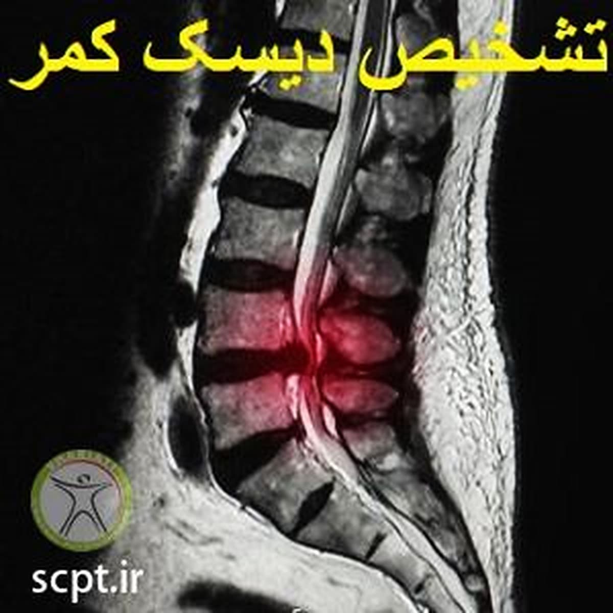 تشخیص دیسک کمر-فیزیوتراپی شریعتی-دکتر رضایی