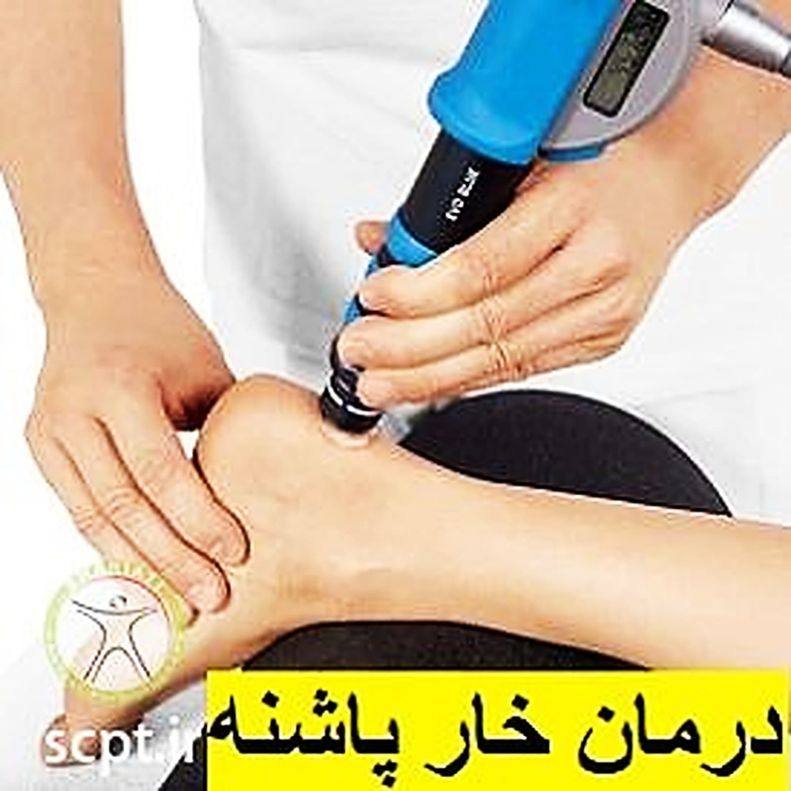 درمان موثر خار پاشنه با فیزیوتراپی و شاک ویو دکتر رضایی