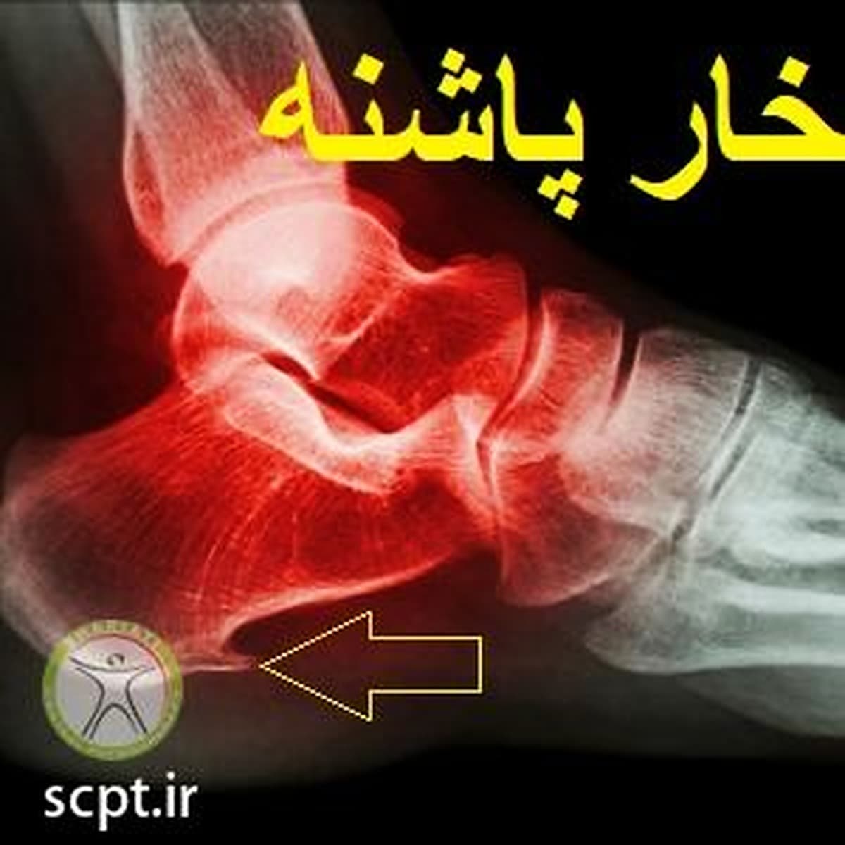 خار پاشنه-فیزیوتراپی شریعتی-دکتر رضایی