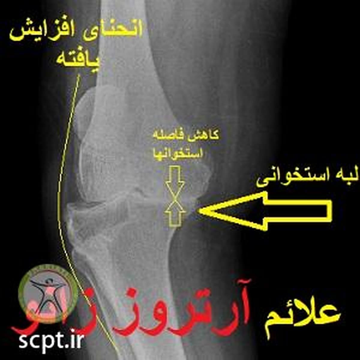 درمان آرتروز زانو-علت و علائم-پیشگیری از آرتروز زانو با ورزش-درمان غیر جراحی-دکتر اکبر رضایی