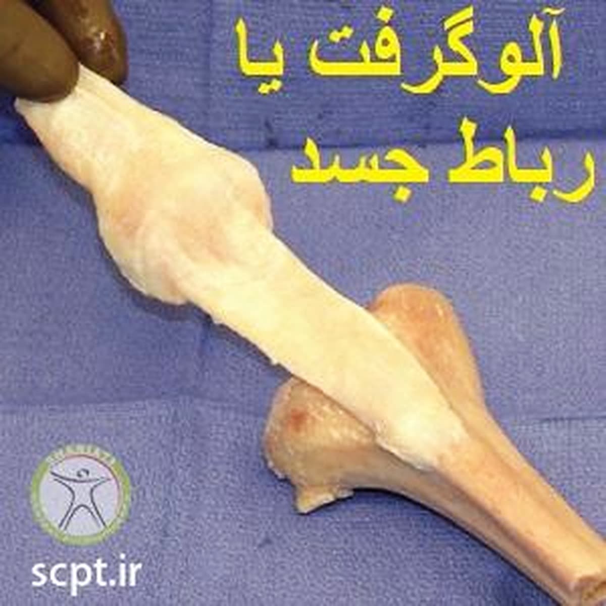 رباط صلیبی مصنوعی بهتر است یا طبیعی-فیزیوتراپی شریعتی-دکتر رضایی