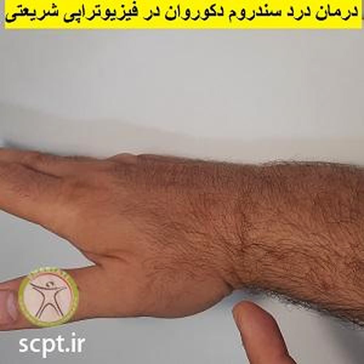 سندروم دکوروان-درد دست مادران شیرده-علل علائم تشخیص و درمان فیزیوتراپی شریعتی