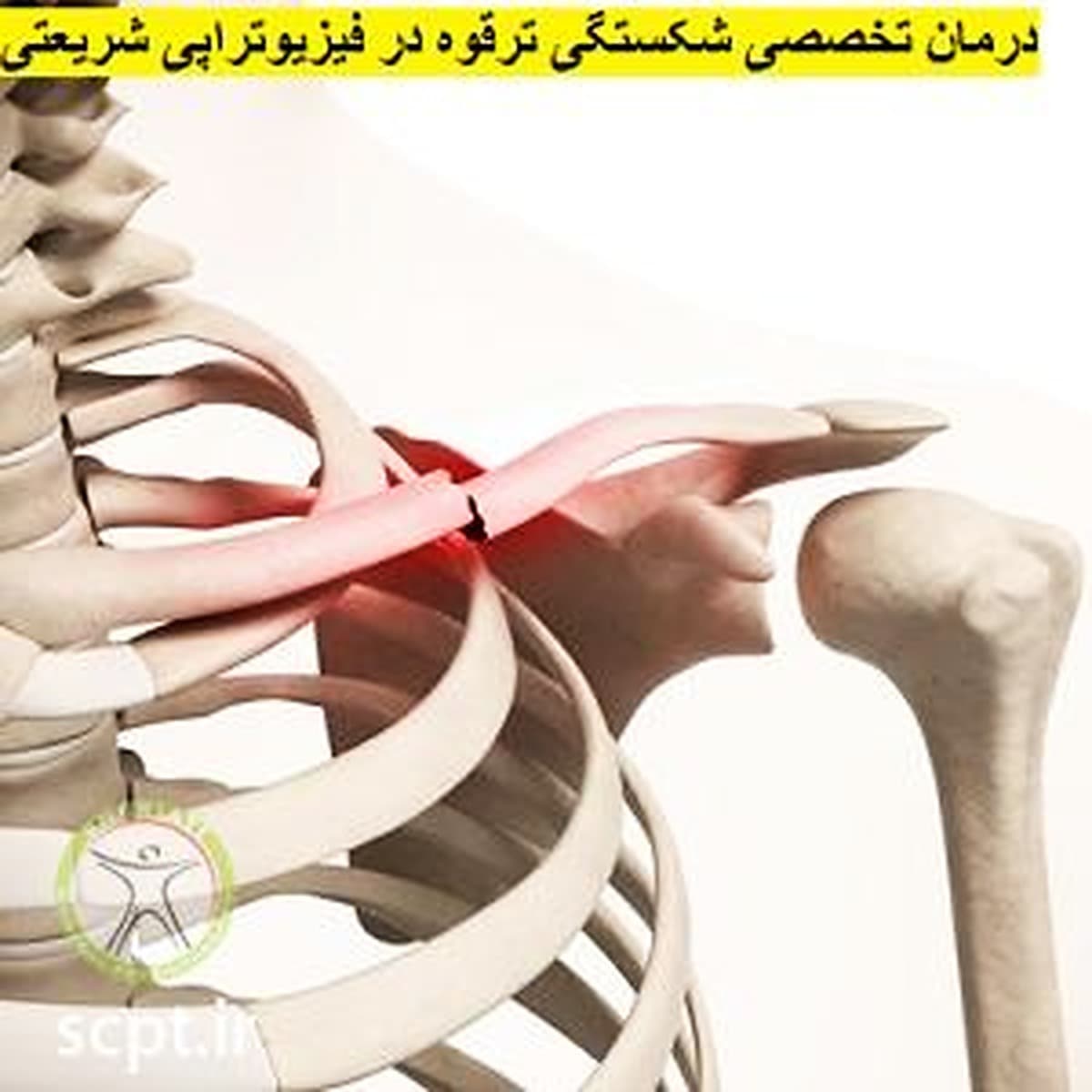 درمان شکستگی ترقوه در فیزیوتراپی تخصصی شریعتی