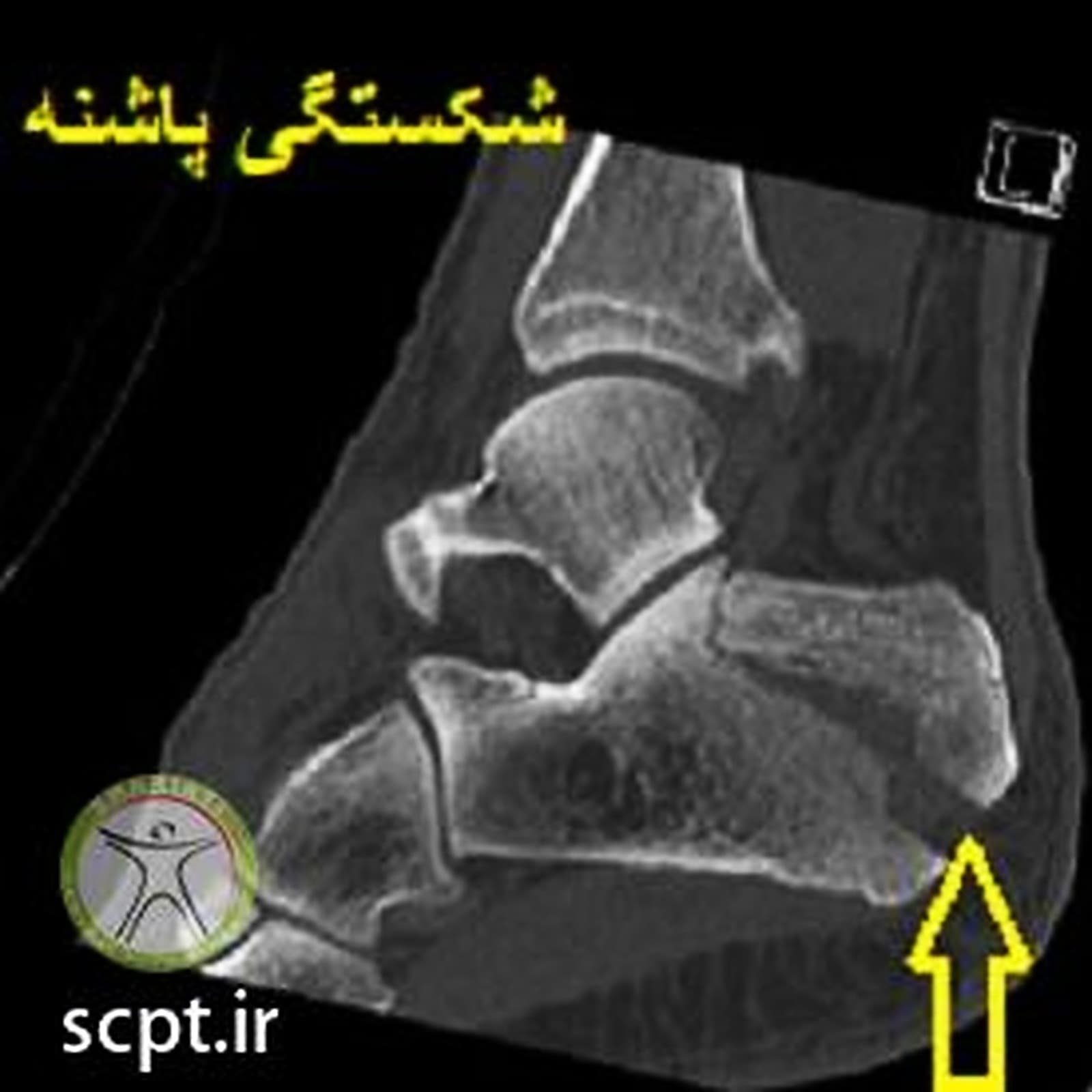 شکستگی پاشنه-بهترین فیزیوتراپی کالکانئوس-کلینیک فیزیوتراپی شریعتی-دکتر اکبر رضایی