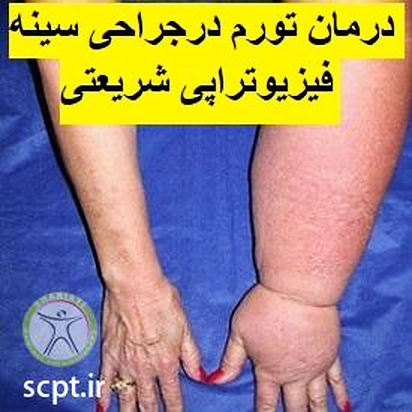لنفوتراپی-درمان لنف ادم-ماساژ ورم دست و پا-وازوترین-فیزیوتراپی شریعتی