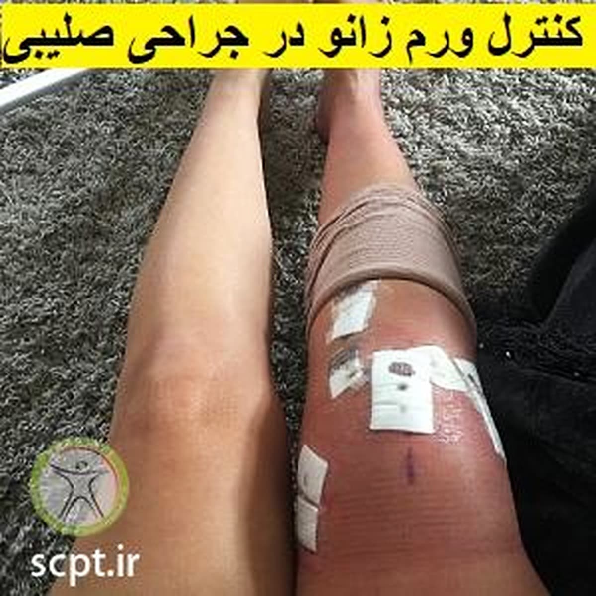 ورم پا بعد از عمل رباط صلیبی-فیزیوتراپی شریعتی-دکتر رضایی
