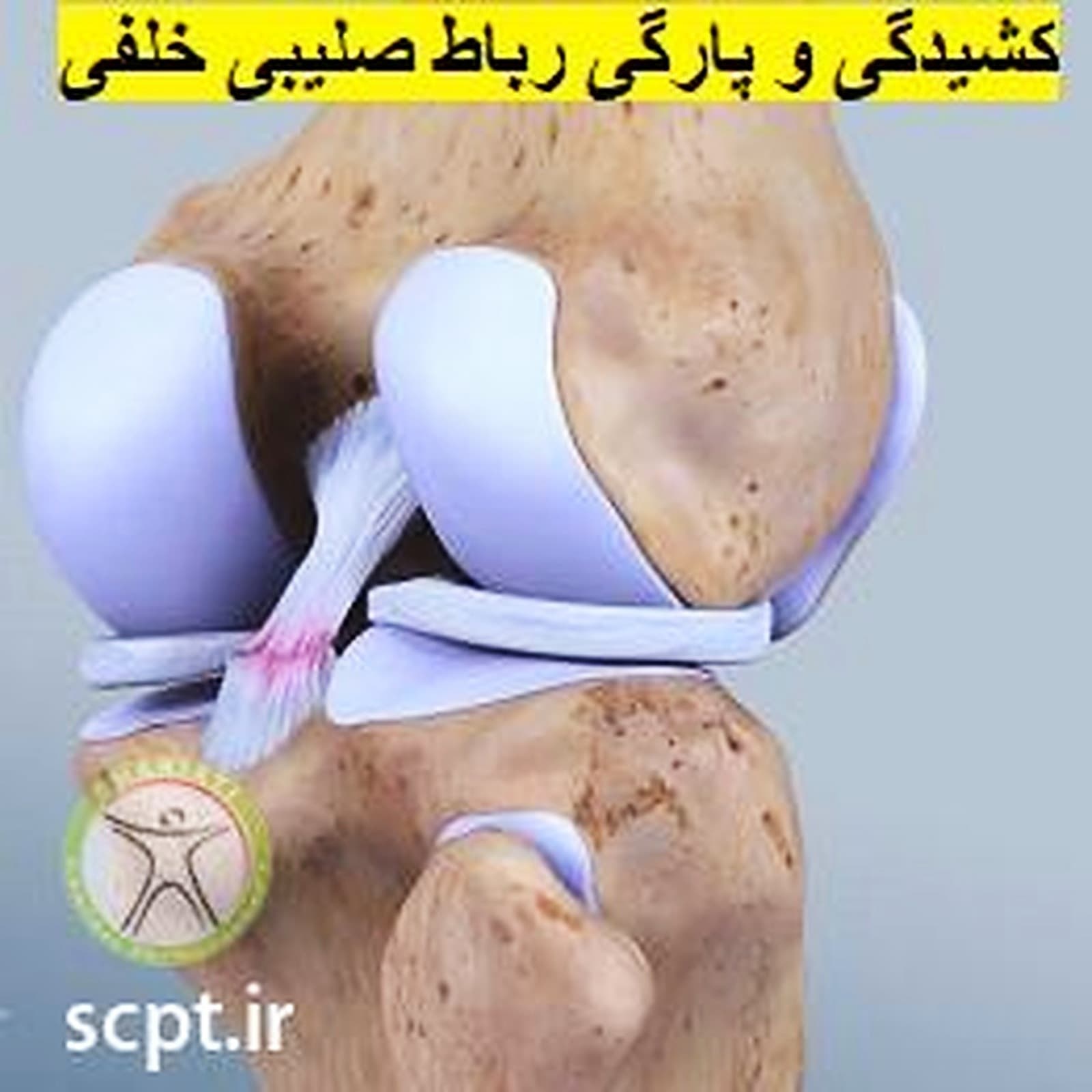 پارگی رباط صلیبی خلفی PCL-تشخیص و درمان فیزیوتراپی-کلینیک شریعتی