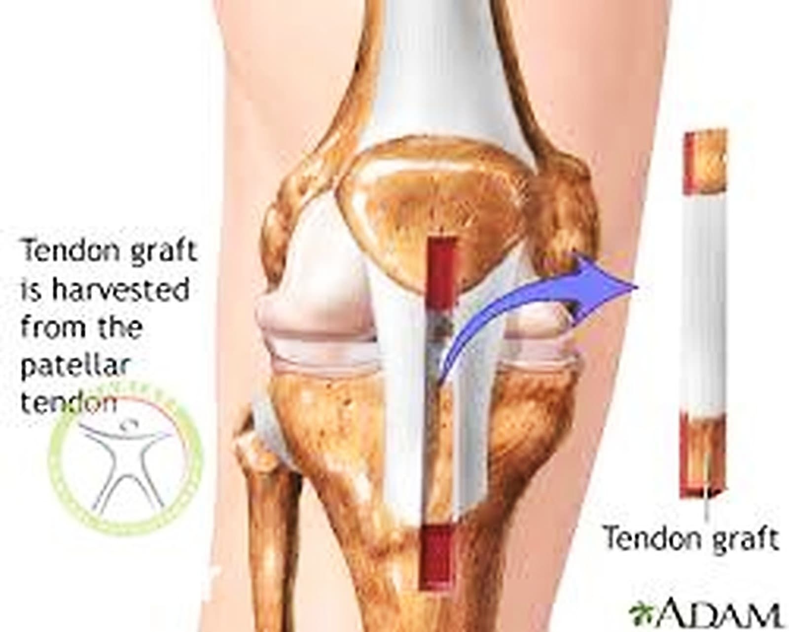 راهنما و بررسی های دقیق مقایسه‌ای بین تکنیک‌ های جراحی رباط صلیبی قدامی ACL