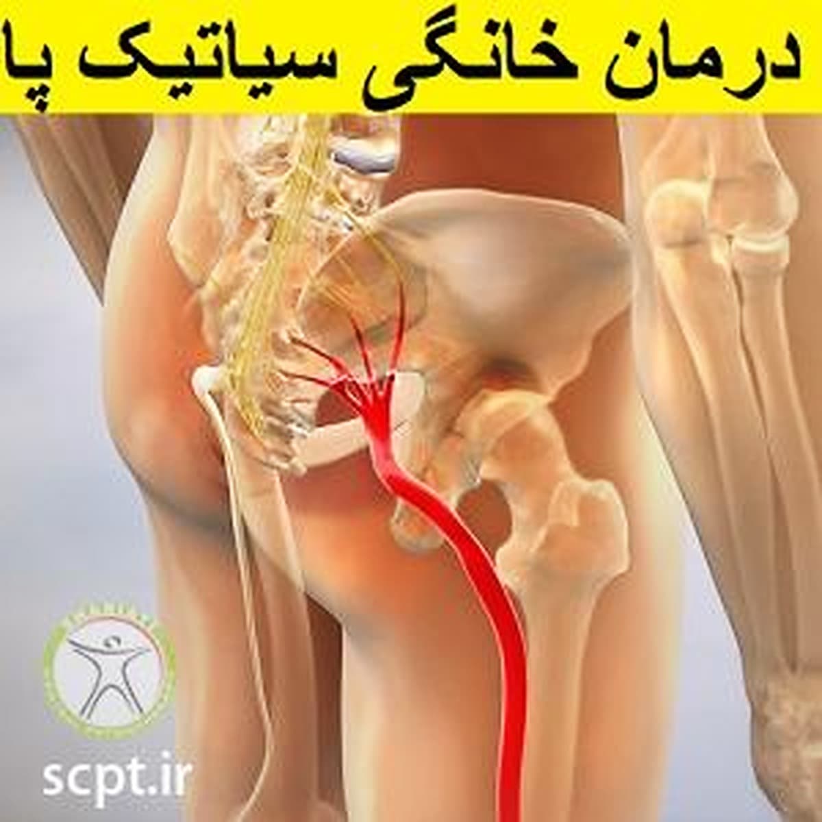 درمان خانگی سیاتیک پا-دکتر رضایی