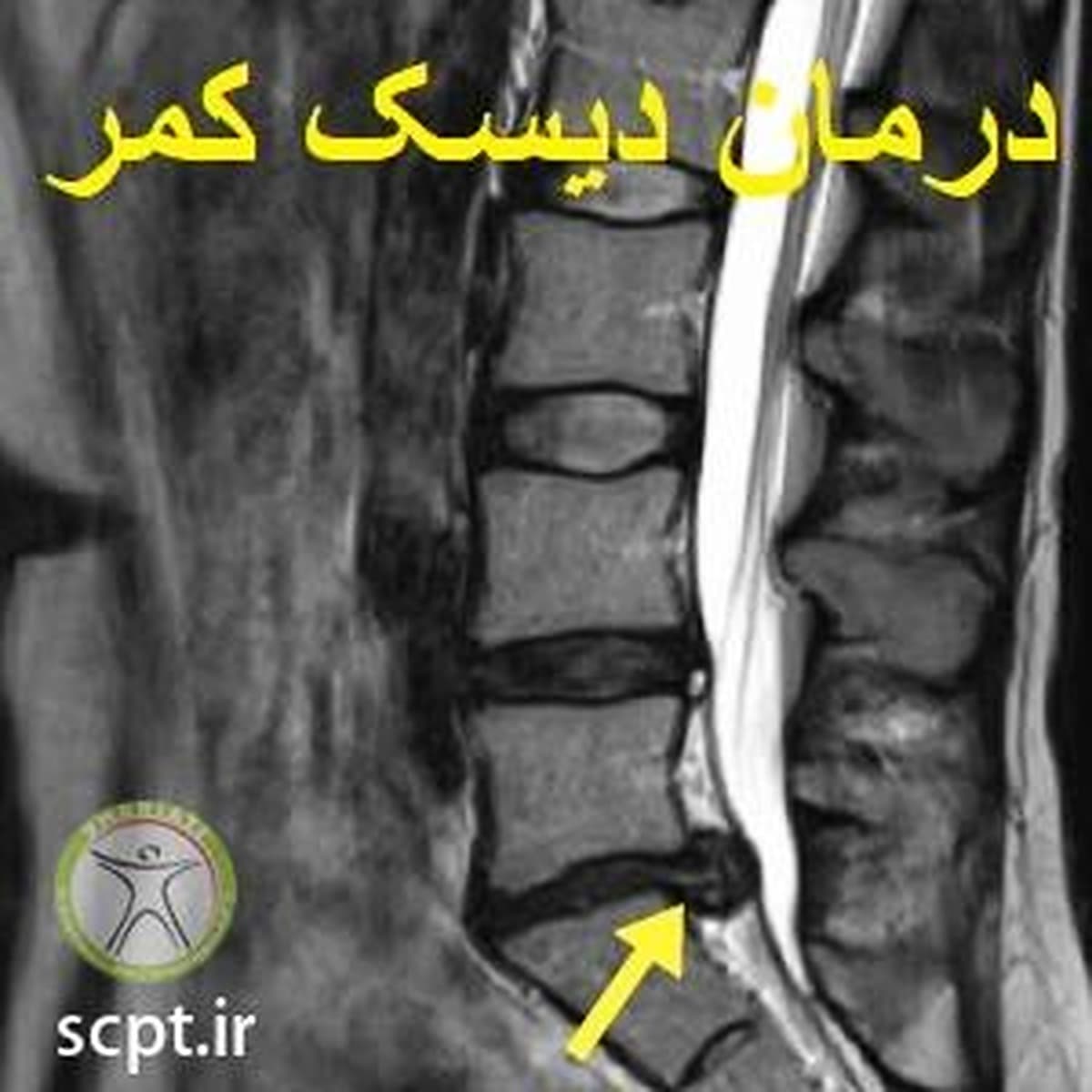 دیسک کمر-دکتر رضایی-فیزیوتراپی سید خندان