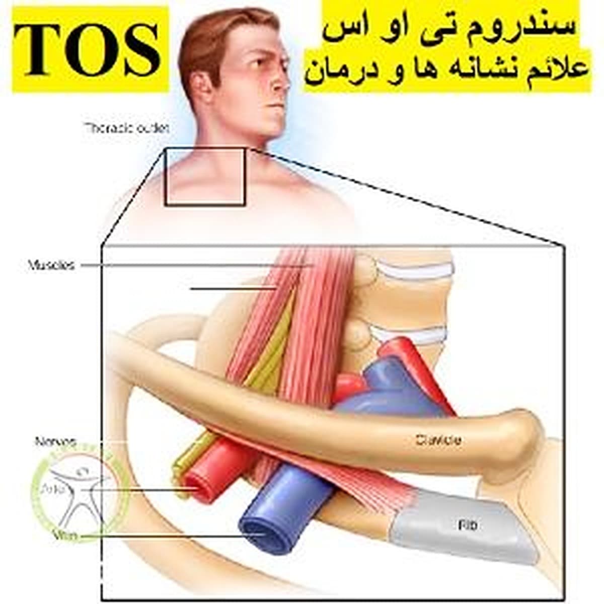 تی او اس TOS یا سندروم توراسیک اوت لت-گزگز دستها و مور مور-علائم نشانه ها و درمان فیزیوتراپی سندروم خروجی توراکس-دکتر رضایی