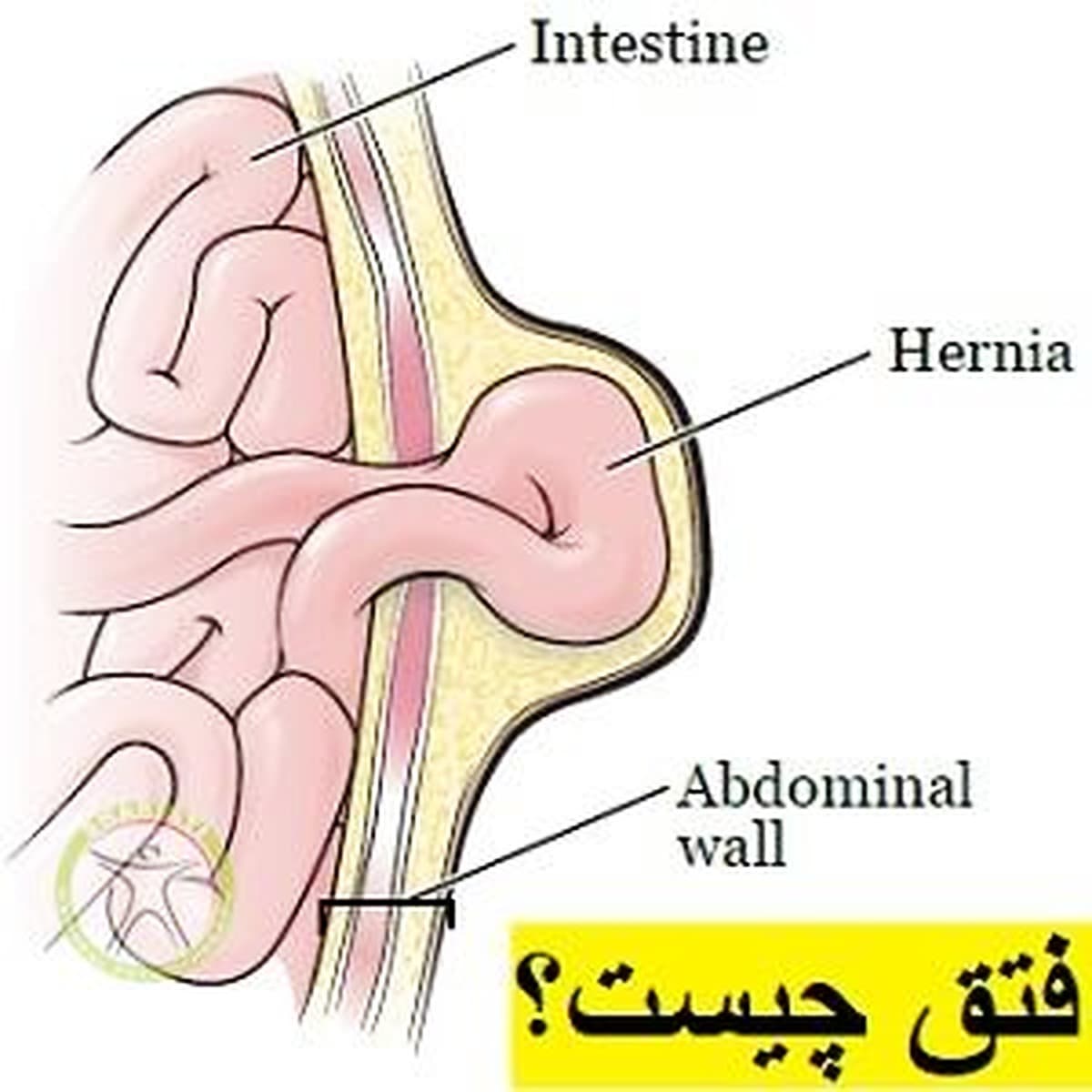 عارضه فتق