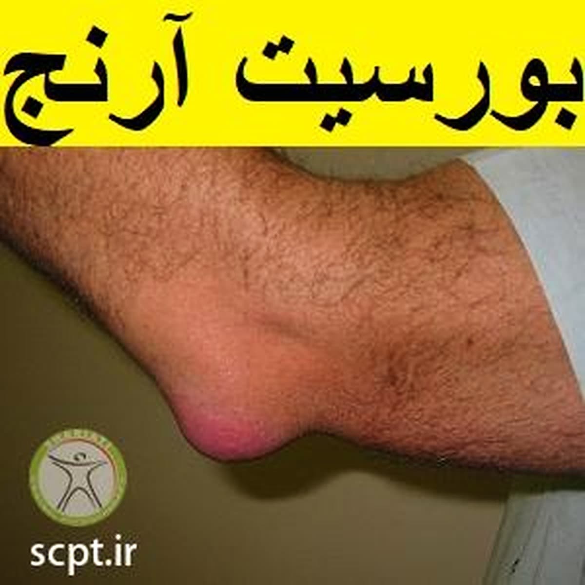 بورسیت آرنج