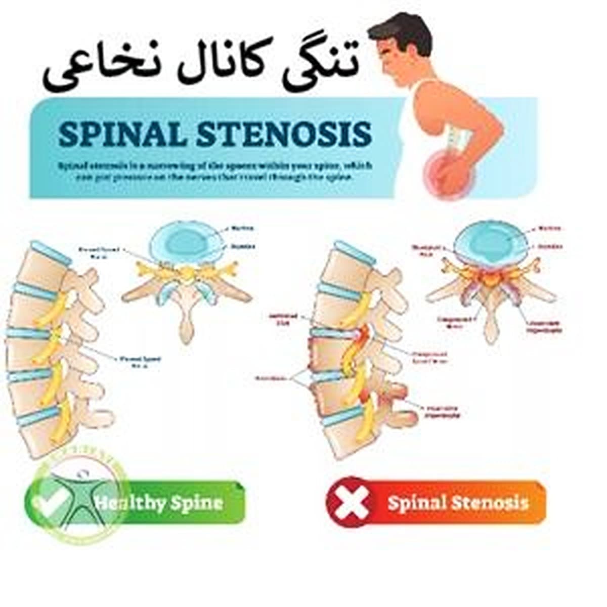 ورزش برای تنگی کانال نخاعی-دکتر رضایی-فیزیوتراپی شریعتی