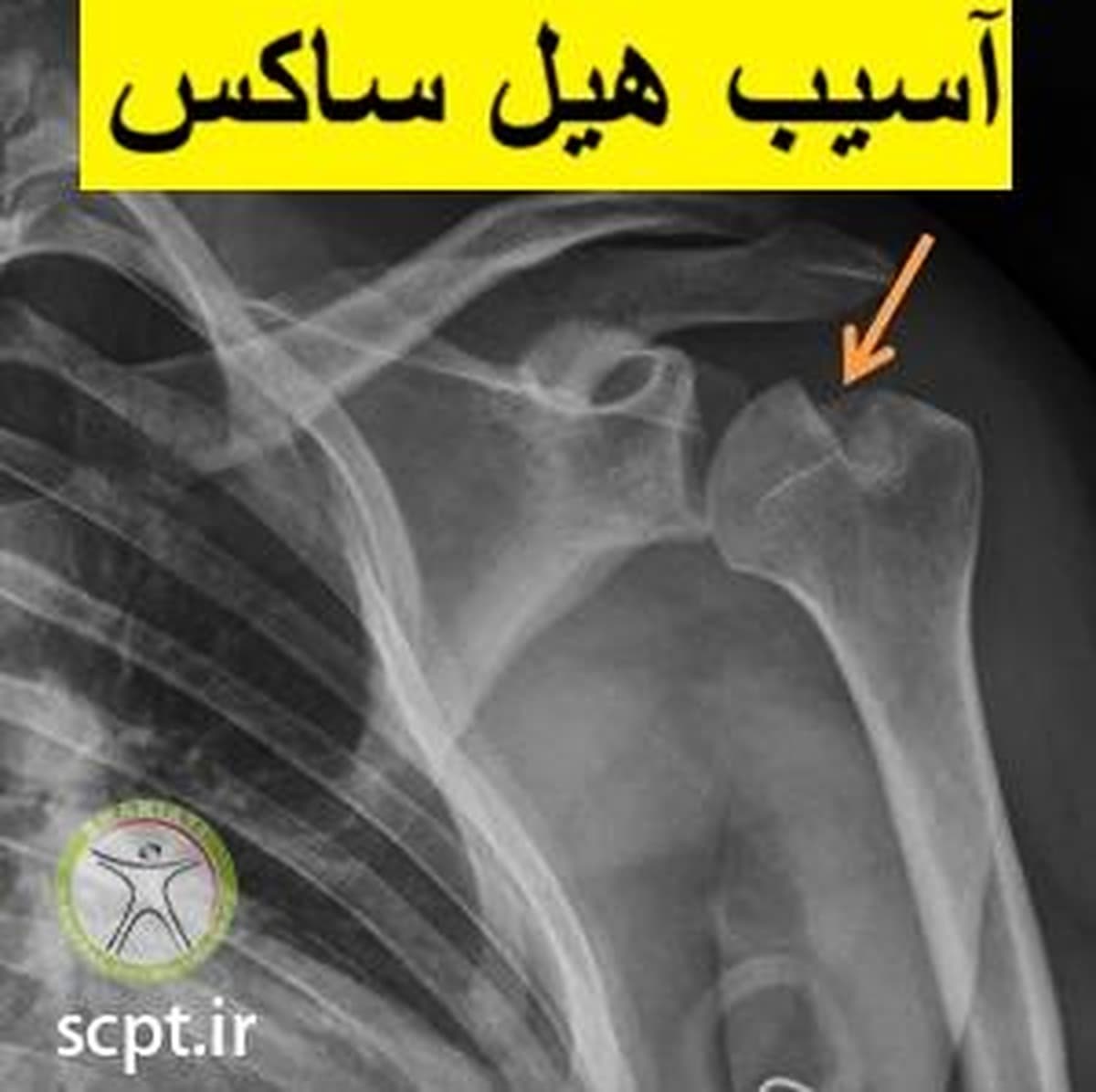 آسیب هیل ساکس شانه