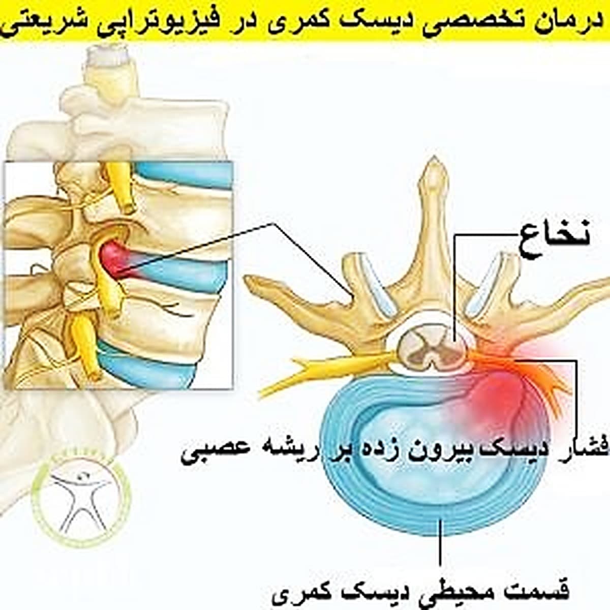 فیلم درمان دیسک کمر با ورزش-دکتر رضایی