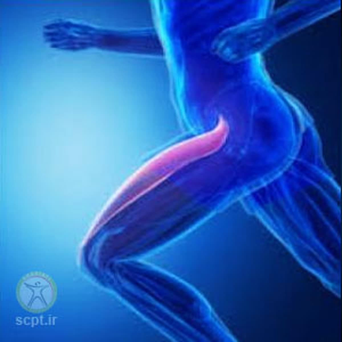 پارگی عضلات راست رانی+رکتوس فموریس