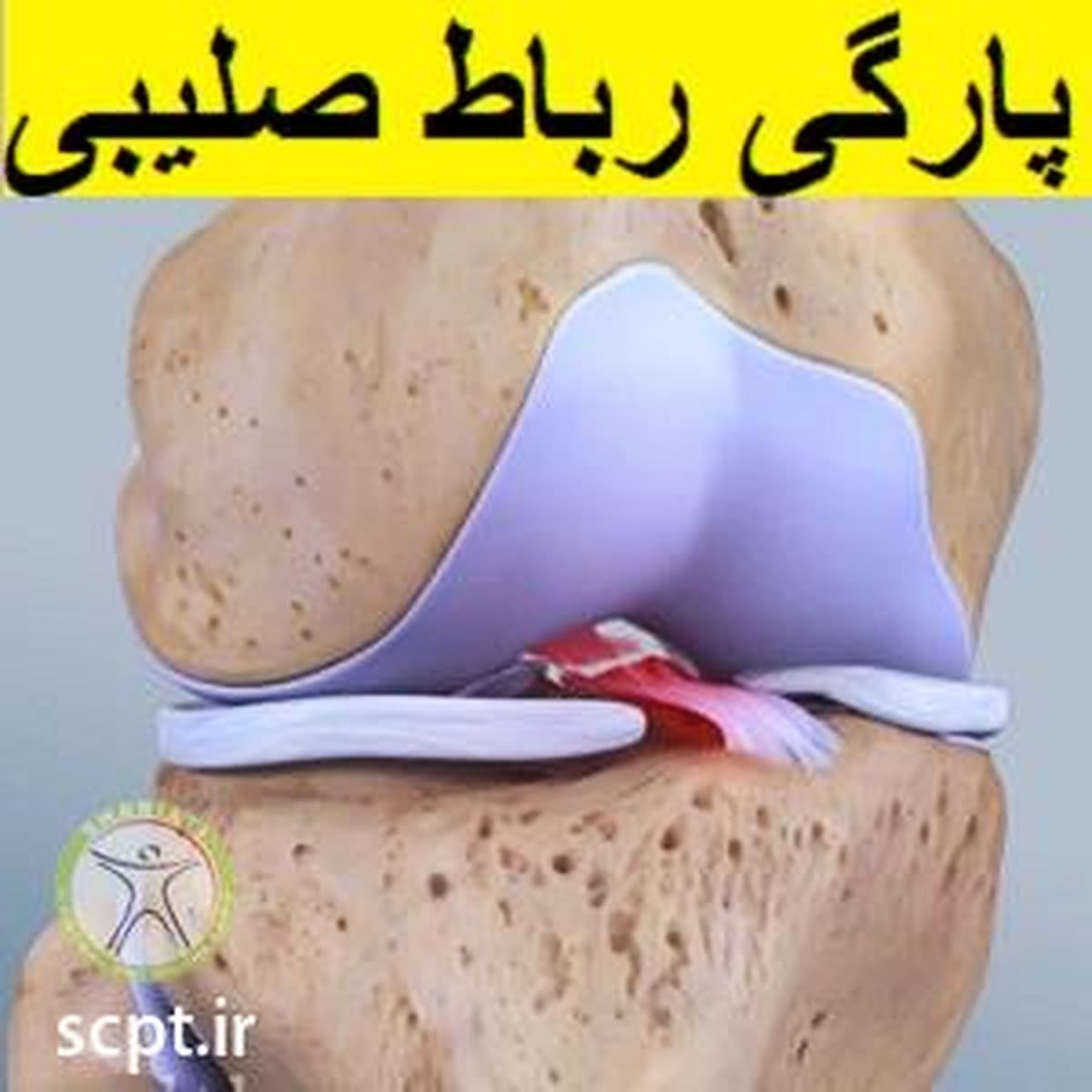 پارگی رباط صلیبی