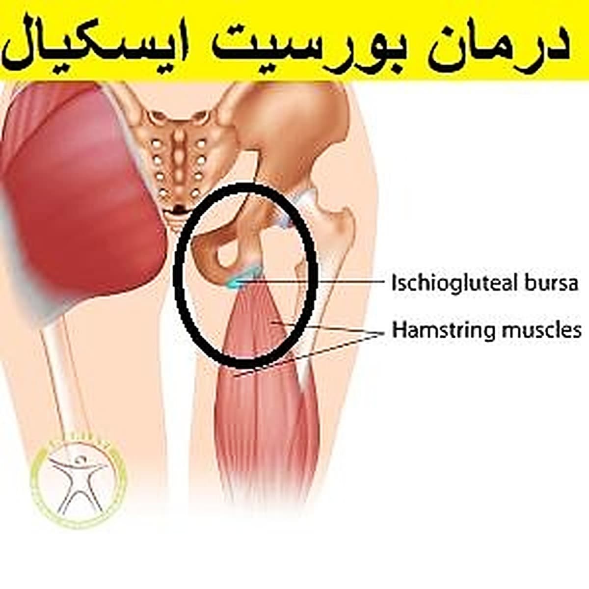 درمان تخصصی بورسیت ایسکیال-دکتر رضایی