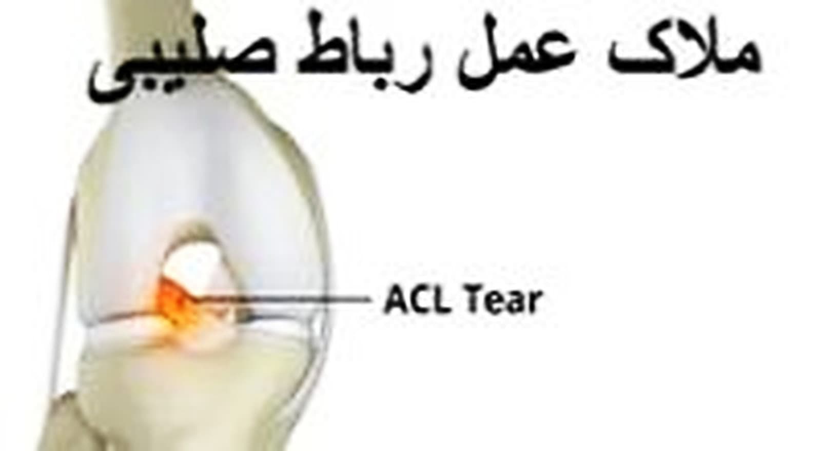 ملاک عمل جراحی رباط صلیبی