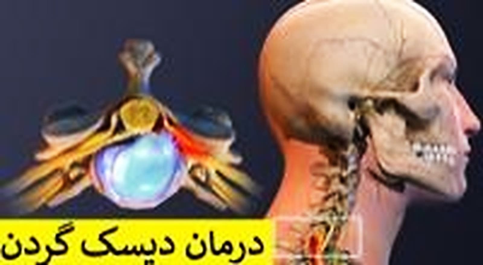 درمان دیسک گردن