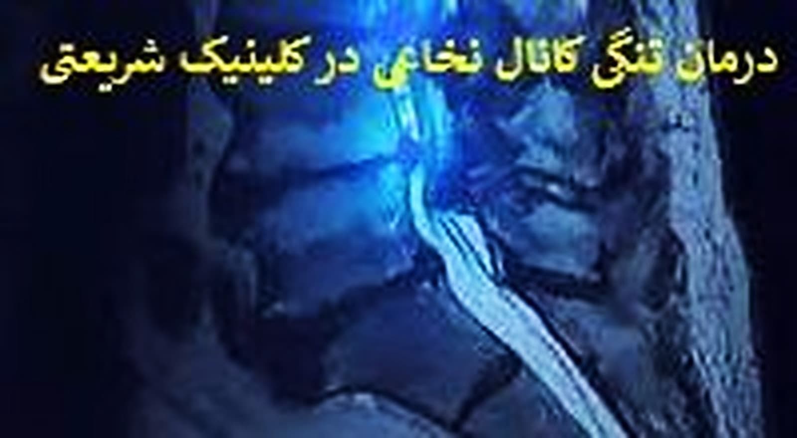 درمان بدون عمل تنگی کانال نخاعی