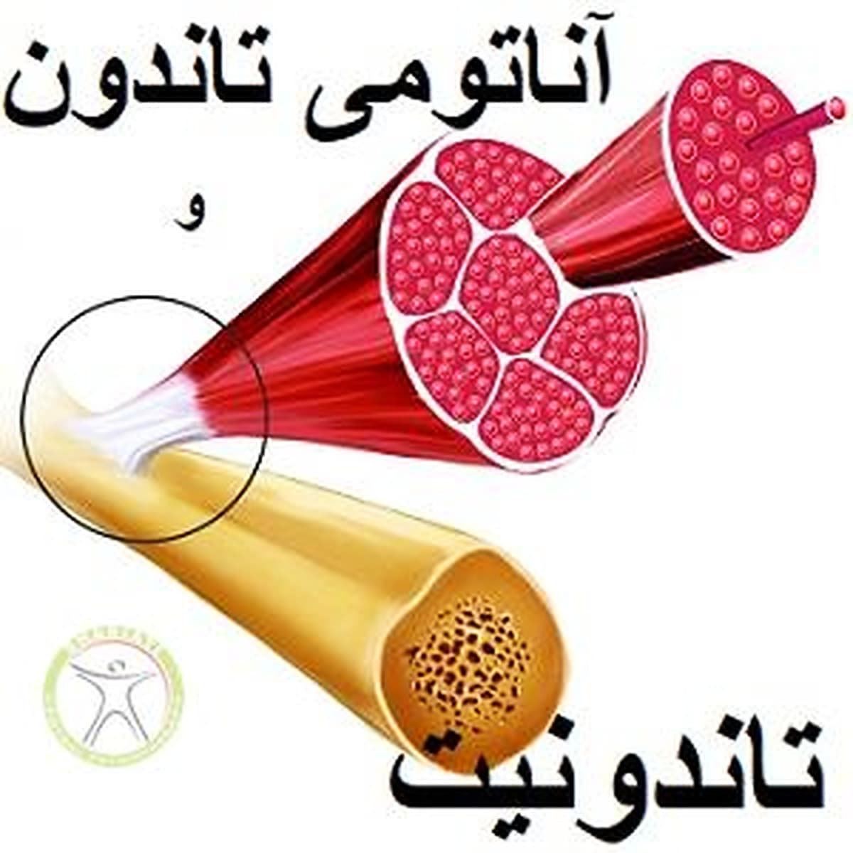 تاندونیت-شانه زانو مچ-تندینوزیس-آناتومی علت علائم درمان و پیشگیری